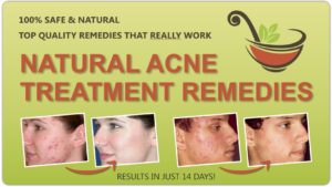 Get Rid of Acne Naturally!